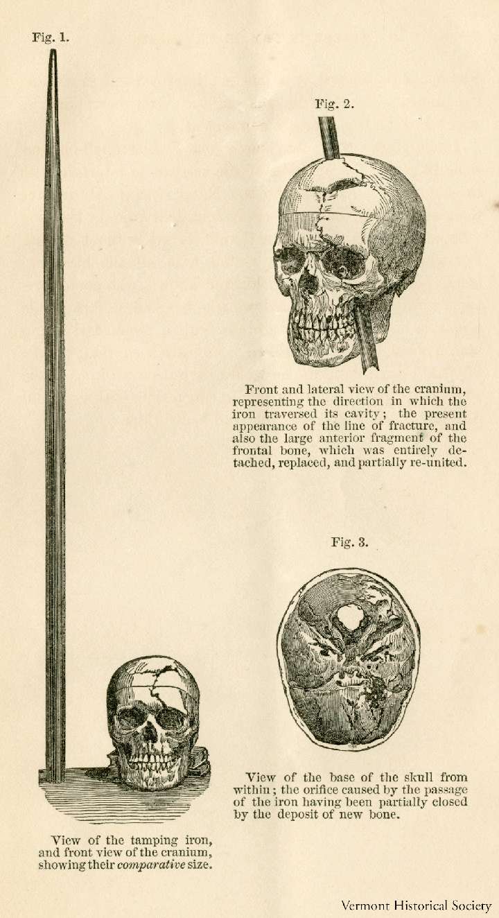 An Accidental Lobotomy| A Medical History 