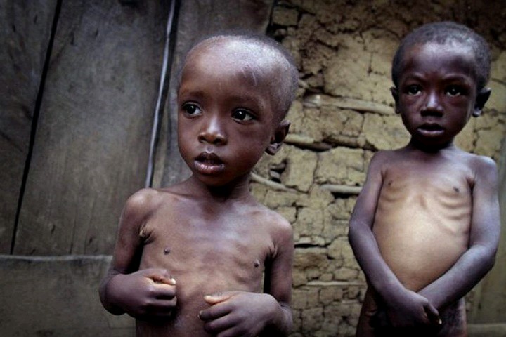 &apos;HealthyLifeMatters: Starvation And Plasma Protein Deficiency — "Kwashiorkor" 