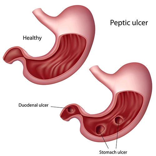 &apos;HealthyLifeMatters: Peptic Ulcer, A Common Killer Disease 