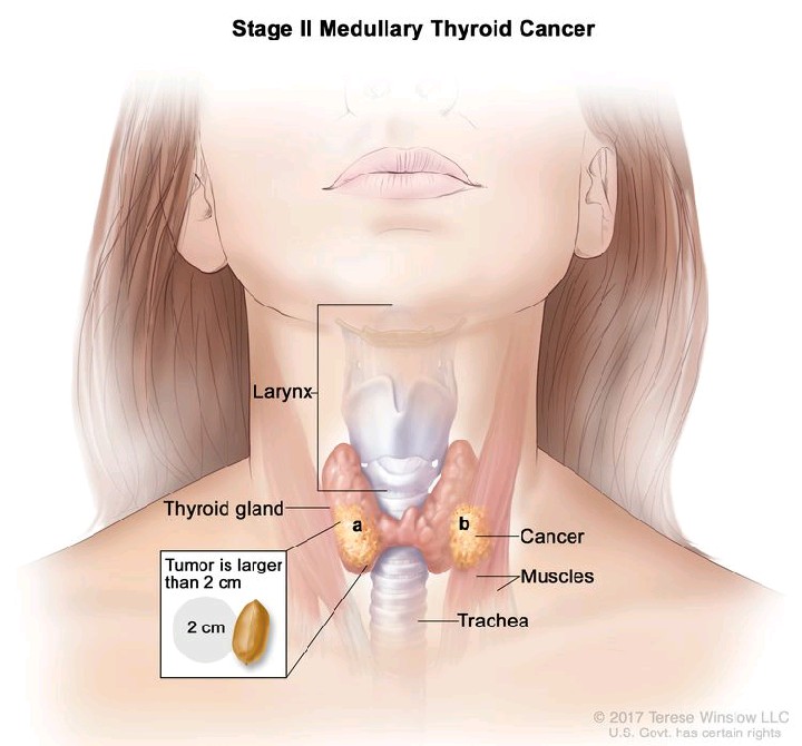&apos;HealthyLifeMatters: A Fatal Effect Of Thyroid Cancer 