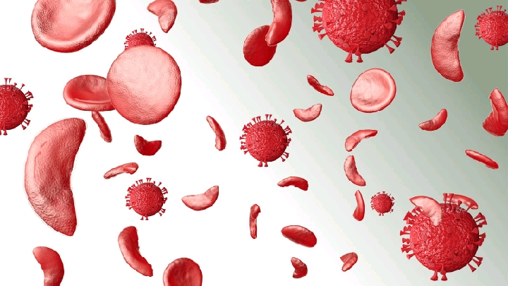&apos;HealthyLifeMatters: Sickle-cell Disease 