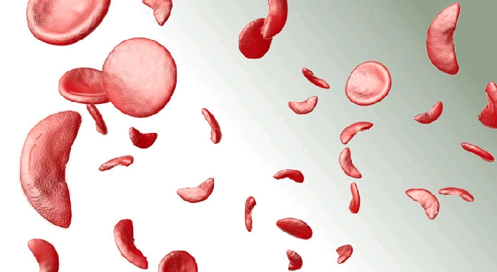 &apos;HealthyLifeMatters: Sickle-cell Disease 