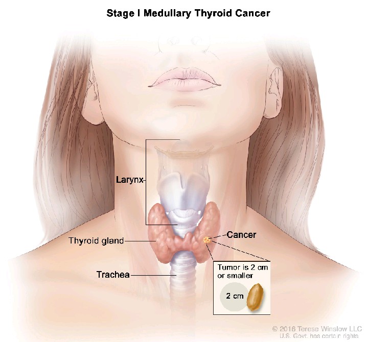 &apos;HealthyLifeMatters: A Fatal Effect Of Thyroid Cancer 