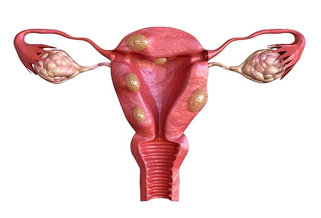 For Women: 6 Things That Can Increase Your Risk Of Developing Fibroid