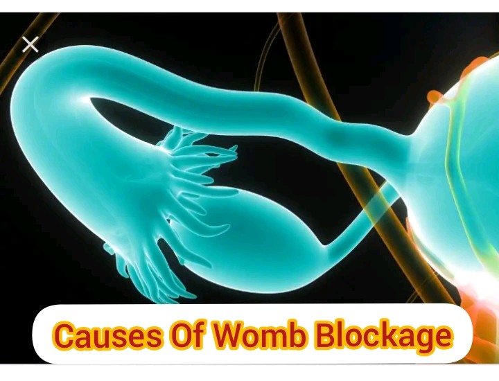Common Causes Of Womb Blockage, Every Woman Should Know