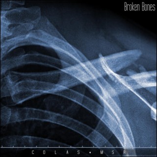 Broken Bones