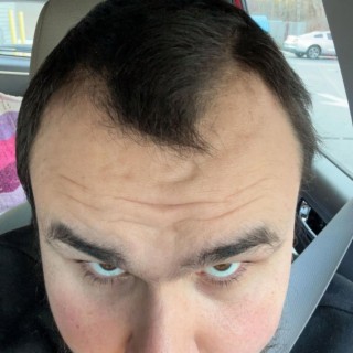 Receded Hair Line