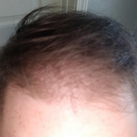 Premature Male Pattern Baldness