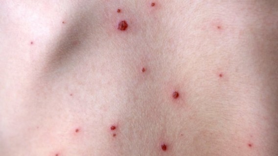 HIQA recommends adding chickenpox vaccine to the routine childhood immunisations