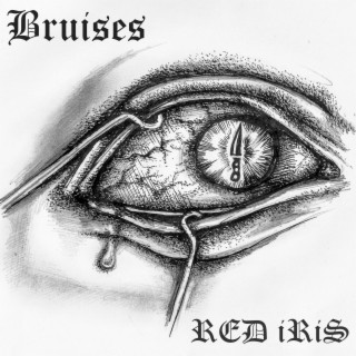 Bruises