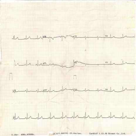 Heart Rate