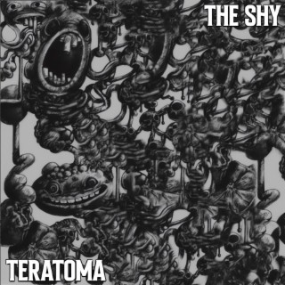 Teratoma