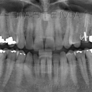 Diastema