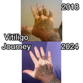 Vitiligo