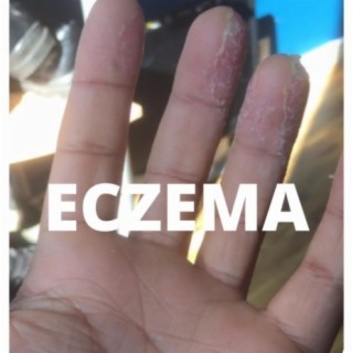 Eczema