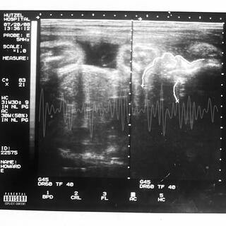 Ultrasound