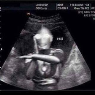 Ultrasound