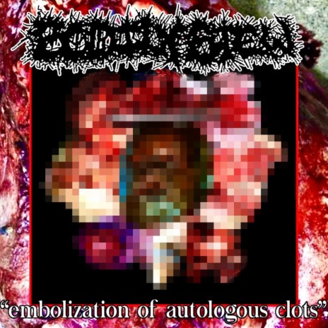 EMBOLIZATION OF AUTOLOGOUS CLOTS | Boomplay Music