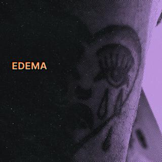 EDEMA