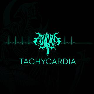 Tachycardia