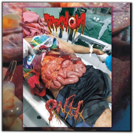 Trachoma - Cavitary Myiasis Mimicking Peritonsilar Abscess ft. Pancreatite Necro Hemorrágica | Boomplay Music