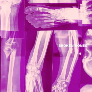 Broken Bones