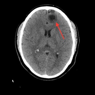 cysticercosis