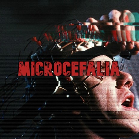 Microcefalia